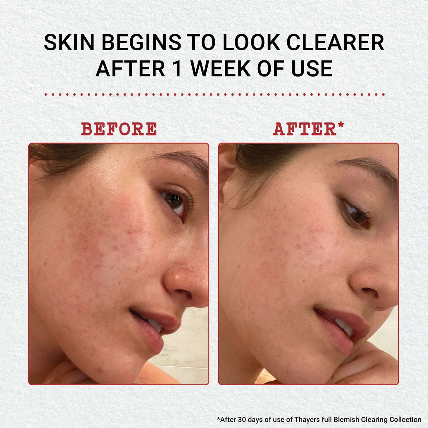 Thayers Blemish Clearing Acne Pads, Salicylic Acid Acne Treatment for Face, Pore Reducing, Exfoliating, and Soothing Skincare, Witch Hazel Toner Pads, 60 Ct