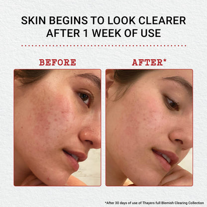 Thayers Blemish Clearing Acne Pads, Salicylic Acid Acne Treatment for Face, Pore Reducing, Exfoliating, and Soothing Skincare, Witch Hazel Toner Pads, 60 Ct